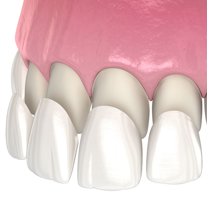 teeth veneers procedure